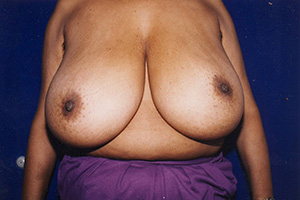 Breast Reduction 5a